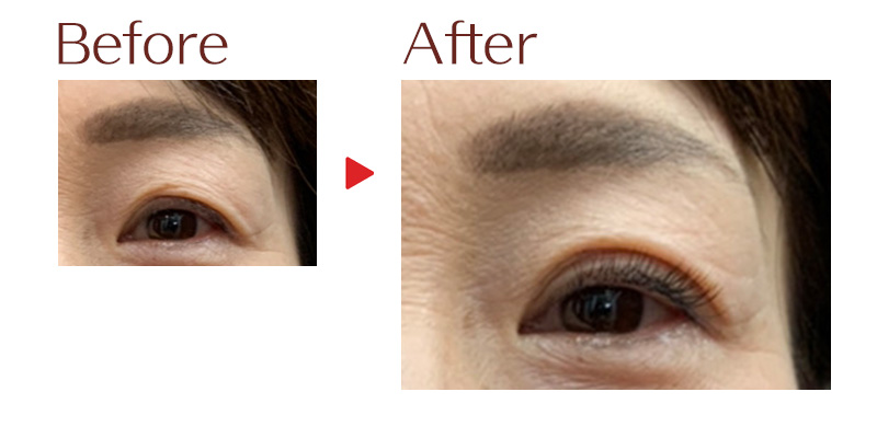 目元のビフォーアフター1